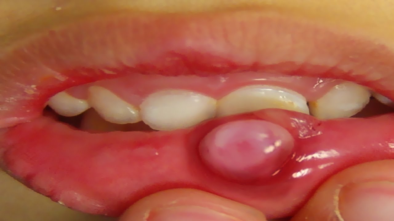 cyst in mouth