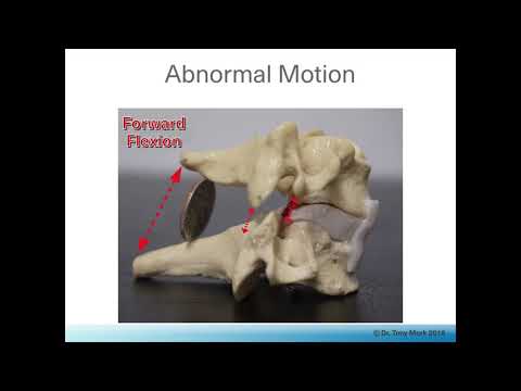 Cervical Facet Syndrome