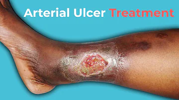 What Are Arterial Ulcers? Arterial Ulcer Treatment