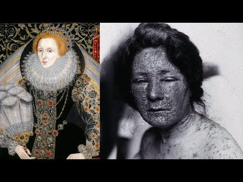 Video: Elizabeth 1 aveva il vaiolo?