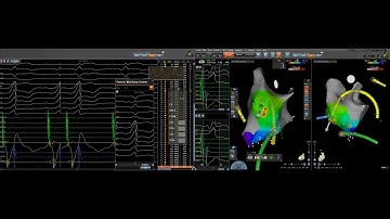 Confidense Automatic Mapping, Left Accessory Pathway Manifest