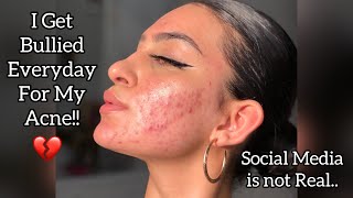 I Get Bullied Everyday Because of My ACNE 💔 ..! Reality of Social Media.