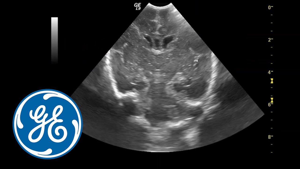 Ultrasound Of The Neonatal Head And Spine Ge Healthcare Youtube