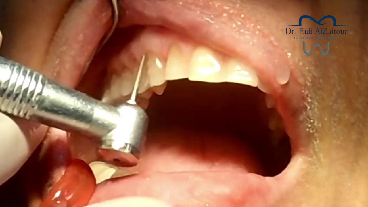 Maxillary eMax veneers preparation تحضير الأسنان العلوية لاستقبال