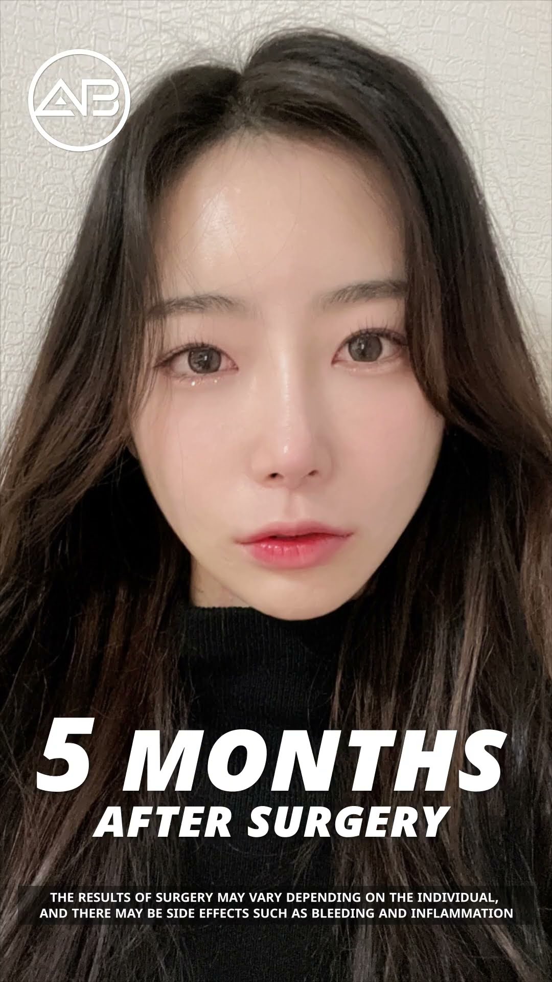 [Plastic surgery in Korea] Double Eyelids + Rhinoplasty + Facial Contouring Surgery