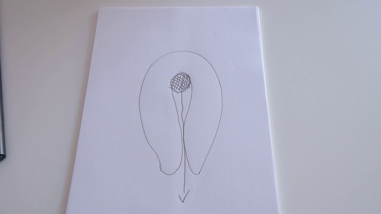 fibromi uterini by Eleonora Castellacci Ginecologia Isteroscopia