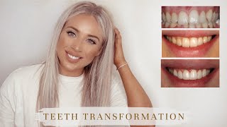 TEETH TRANSFORMATION | INVISALIGN, COMPOSITE BONDING, GUM CONTOURING & TEETH WHITENING