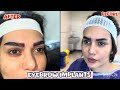Natural Eyebrow Transplant Transformation | Full Process & Results