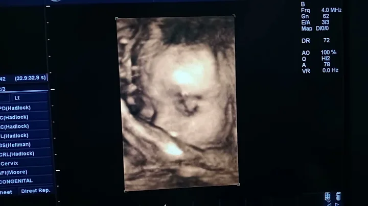4D ultrasound of our baby Allen | 28 weeks & 5 days