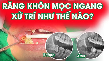 Cận cảnh nhổ bỏ răng khôn nằm ngang, mọc lệch 90 độ đâm vào răng số 7