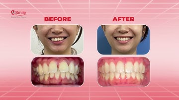 Khắc Phục Tình Trạng Hô, Hở Kẻ Giữa 2 Răng Cửa Với Niềng Trong Suốt AI SMILE