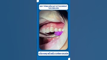 Quy trình gắn hạt Attachment khi niềng răng khay trong suốt Vinalign  #niengrang #dentist