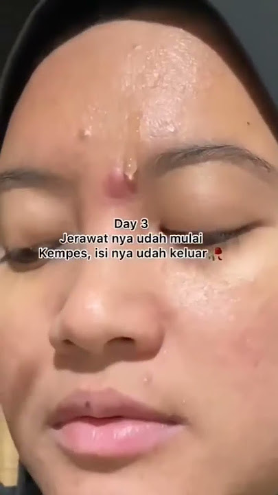 Jerawat batu hilang? dalam 5 hari 😱