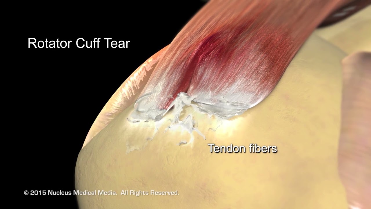 Dr. Broering | Rotator Cuff Repair