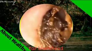 Ear wax removal ( Get rid of ear wax ) #กำจัดขี้หู/ part 17