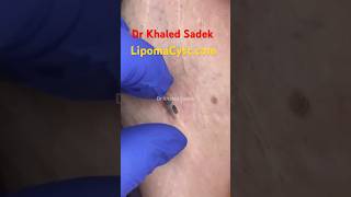 Massive blackhead extraction Dr Khaled Sadek #blackheadremoval #blackheads #skincare