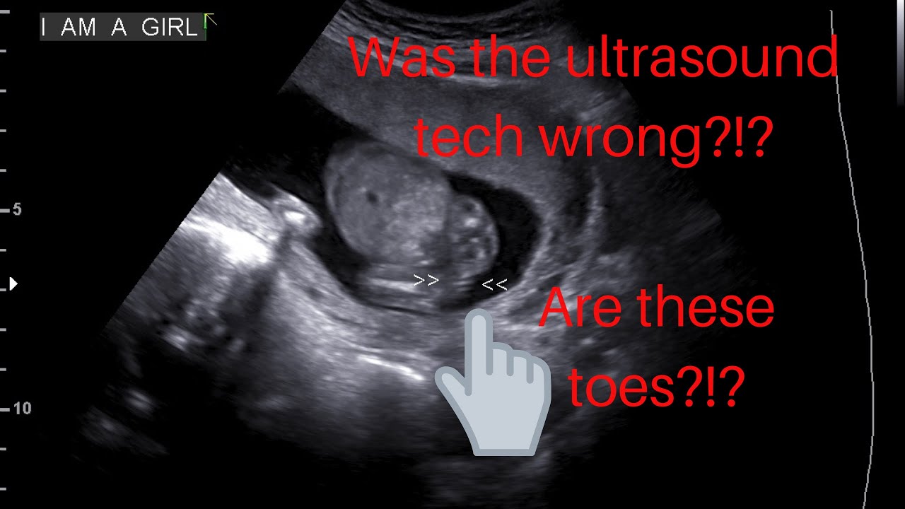 I don’t think the ultrasound tech got a clear picture. The baby was