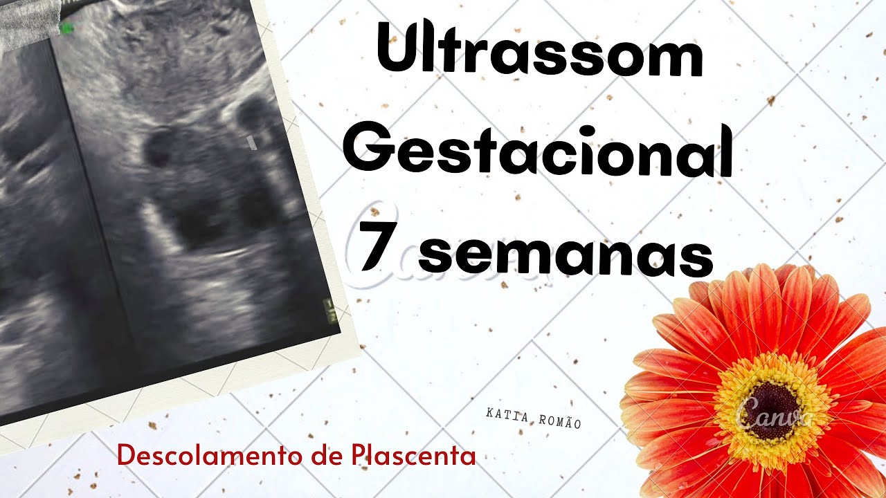 Ultrassom Gestacional 7 semanas Descolamento de placenta YouTube Ultrassom Gestacional 7 semanas Descolamento de placenta YouTube