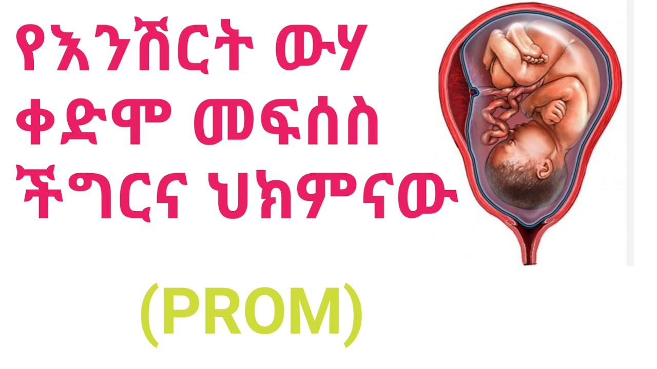 Premature Rupture Of Membrane/የእንሽርት ውሃ ያለጊዜው መፍሰስ የሚያስከትለውን ችግርና መፍትሔዎቹን ከዚህ ቪድዮ!