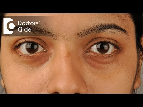 How to get rid of dark circles and hollow eyes? - Dr. Deepak P Devakar