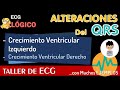 CRECIMIENTO VENTRICULAR IZQUIERDO, CVI, Curso de ELECTROCARDIOGRAM | ECG PATOLÓGICO