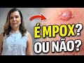 É MPOX ou Não? Saiba Reconhecer os Sinais na Pele