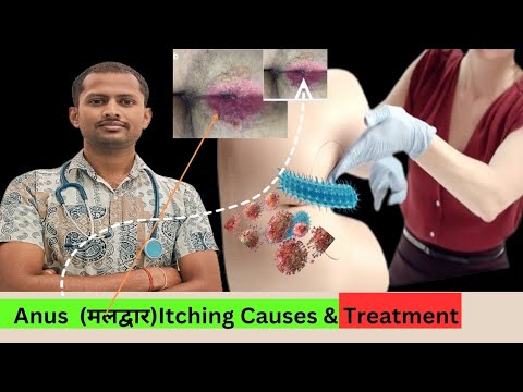 Anus itching causes & treatment | Anus itching symptoms | Anal itching ...