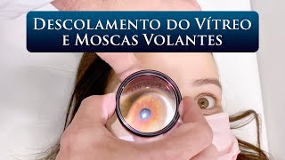 DESCOLAMENTO DO VÍTREO E MOSCAS VOLANTES