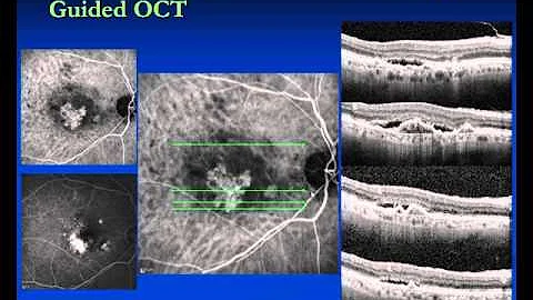 ICG Angiography