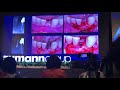 Implant Placement with simultaneous GPR in the mandible - Prof. Buser
