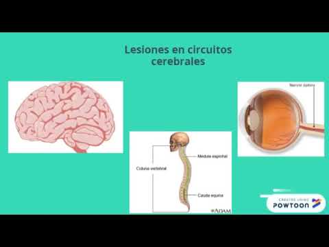 Vídeo: Esclerosis Múltiple (EM) Y Pérdida De Memoria: ¿cuál Es El Vínculo?