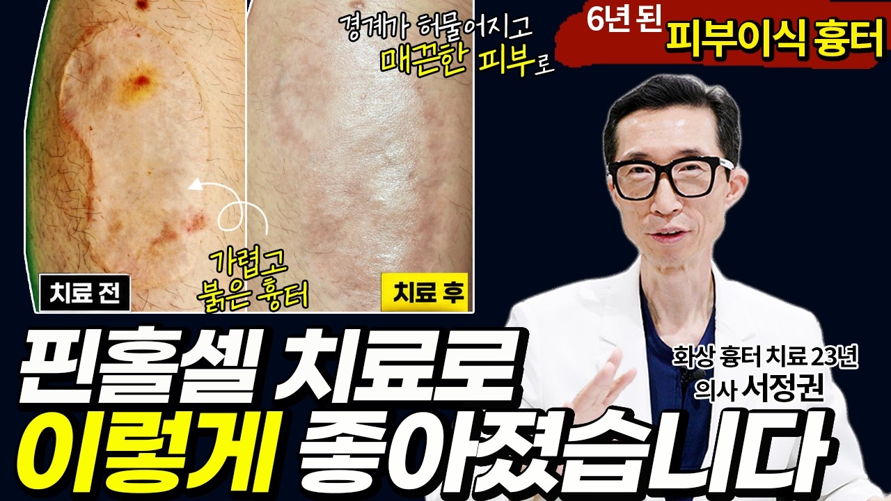 6년 된 피부이식 흉터, 핀홀셀 치료로 어떻게 달라졌을까? | ????실제 치료 사례????