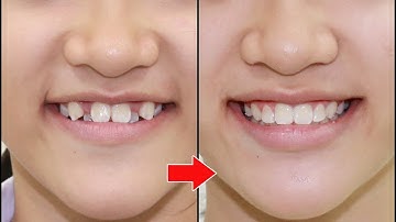 Niềng răng thay đổi nụ cười như thế nào? (Braces change smiles)