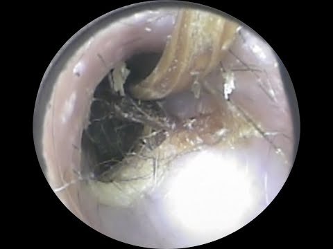 Vol.271【耳掃除】補聴器の調子が悪いと思っていたら・・・左耳取り切れず＋おまけ～eariss