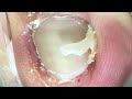 Beautiful toenails hide hooks, solve it!