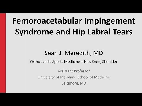 Femoroacetabular Impingement Syndrome and Hip Labral Tears