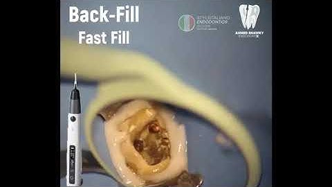 Continuous Wave of Compaction Obturation Technique Eighteeth Obturation System Fast-Pack Fast-Fill