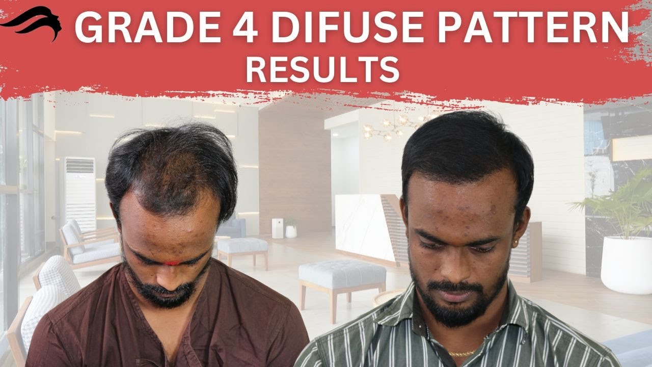 Hair Transplant In Chennai Best Cost Results & Surgeon Of Hair Transplant Of Chennai YouTube