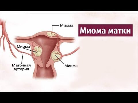 наружное маточное кровотечение - причины и лечение