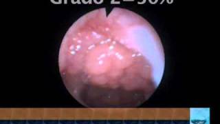 Vasculite de endoscopia gastrointestinal