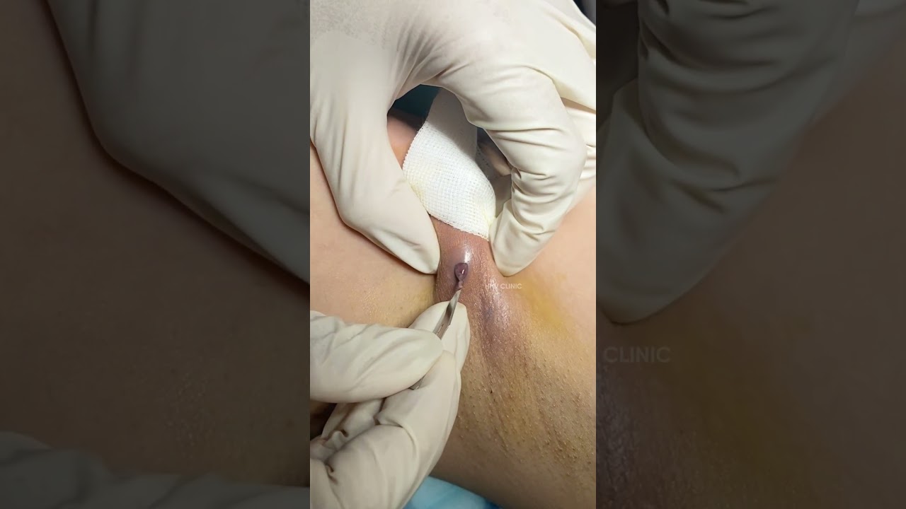 Nặn mụn áp xe ở nách