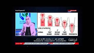 مراحل ودرجات سقوط الرحم وكيفية علاجه