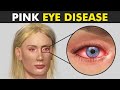 How Conjunctivitis Damages The Eye? (Pink Eye Disease)