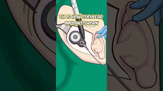 This is how cochlear implants work