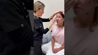 Deep Plane Facelift Series: Part 2 ✨ #penningtonfacialplastics