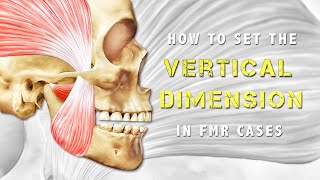 How to determine the VD in an FMR case #Verticaldimension #FMR #VDO