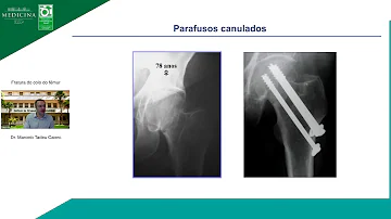 O que é colo do fêmur?
