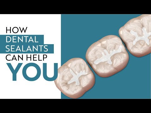 Are Dental Sealants