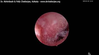 Hysteroscopic bipolar septum resection