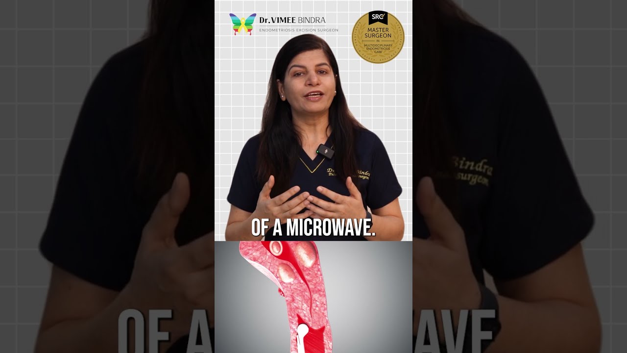 Microwave Ablation For Adenomyosis Dr Vimee Bindra Adenomyosistreatment Drvimee